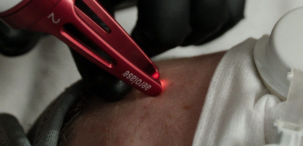 NeoClear Acne Laser - Alchemy Beauty